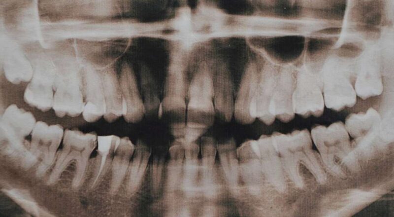 Menino indiano com mais de 500 dentes, mostrando radiografia de dentes supranumerários
